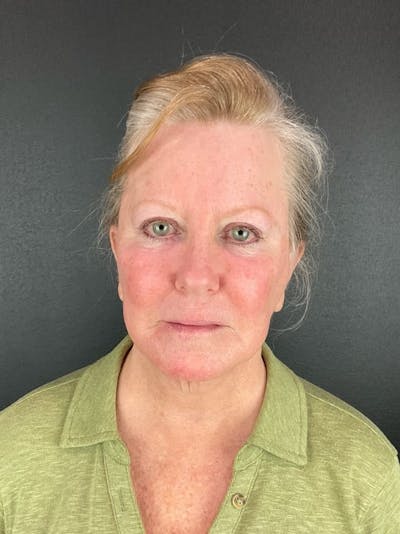Panfacial Fat Grafting Before & After Gallery - Patient 383893 - Image 2