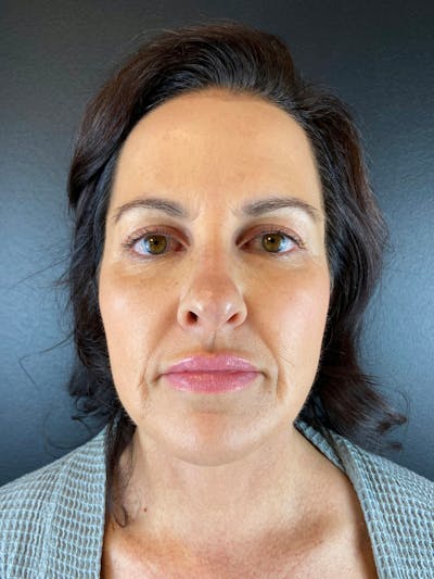 Panfacial Fat Grafting Before & After Gallery - Patient 387987 - Image 2
