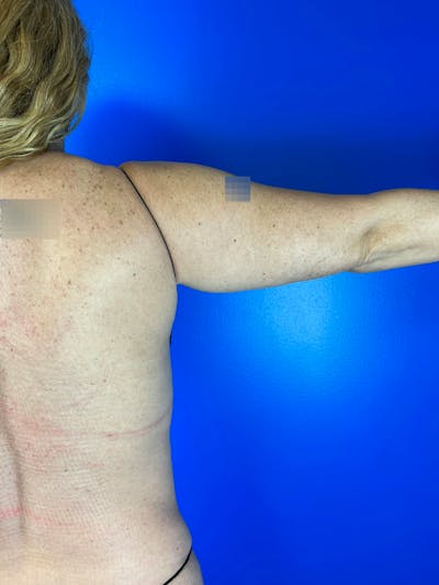 Arms (Liposuction) Before & After Gallery - Patient 292290 - Image 1