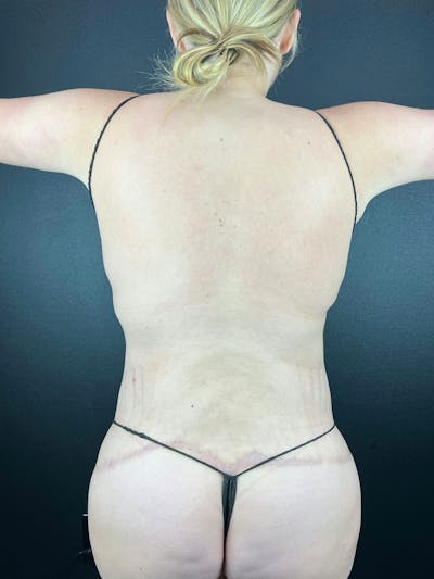 Back (Liposuction) Before & After Gallery - Patient 424819 - Image 2