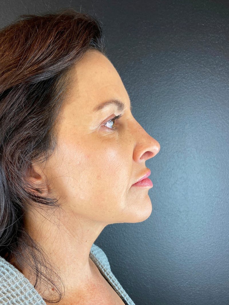 Panfacial Fat Grafting Before & After Gallery - Patient 387987 - Image 4
