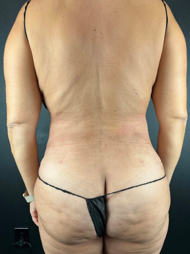 Back (Liposuction) Before & After Gallery - Patient 174163 - Image 2