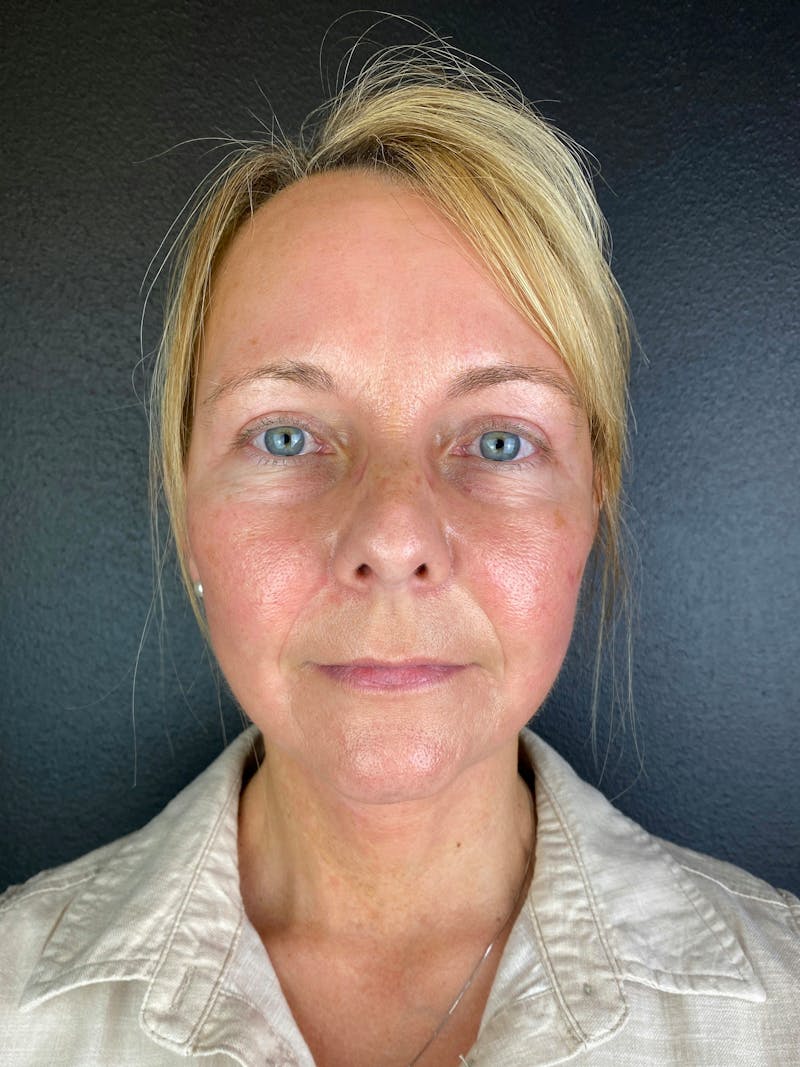 Panfacial Fat Grafting Before & After Gallery - Patient 101127 - Image 2
