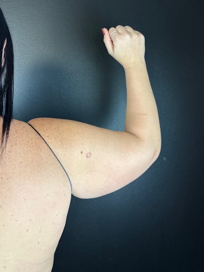 Arms (Liposuction) Before & After Gallery - Patient 229553 - Image 1