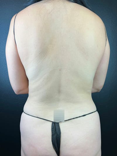 Back (Liposuction) Before & After Gallery - Patient 671642 - Image 1