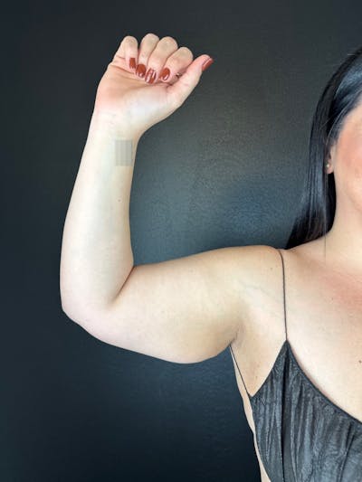 Arms (Liposuction) Before & After Gallery - Patient 252202 - Image 1