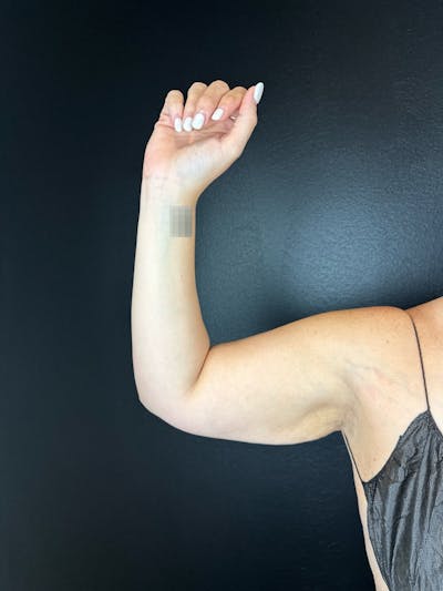 Arms (Liposuction) Before & After Gallery - Patient 252202 - Image 2