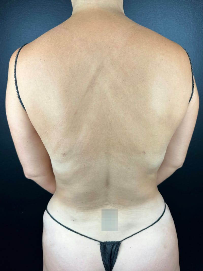 Back (Liposuction) Before & After Gallery - Patient 671642 - Image 2