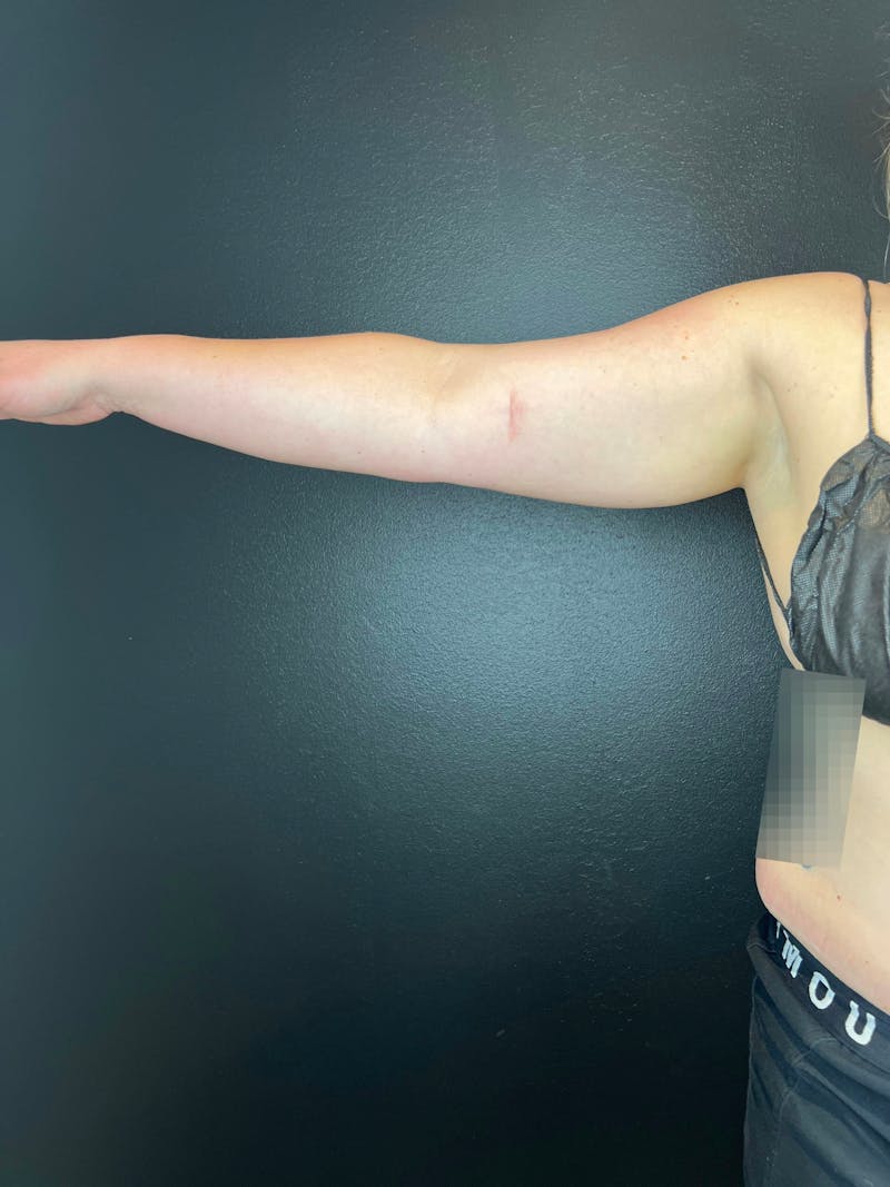 Arms (Liposuction) Before & After Gallery - Patient 238810 - Image 1