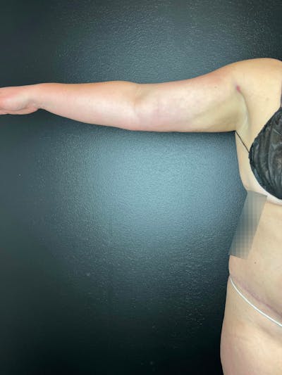 Arms (Liposuction) Before & After Gallery - Patient 238810 - Image 2
