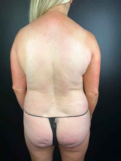 Back (Liposuction) Before & After Gallery - Patient 343120 - Image 2