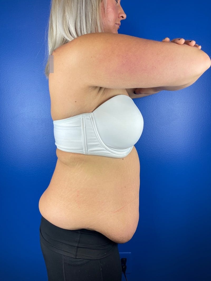 Lower Body Lift Before & After Gallery - Patient 175778 - Image 1