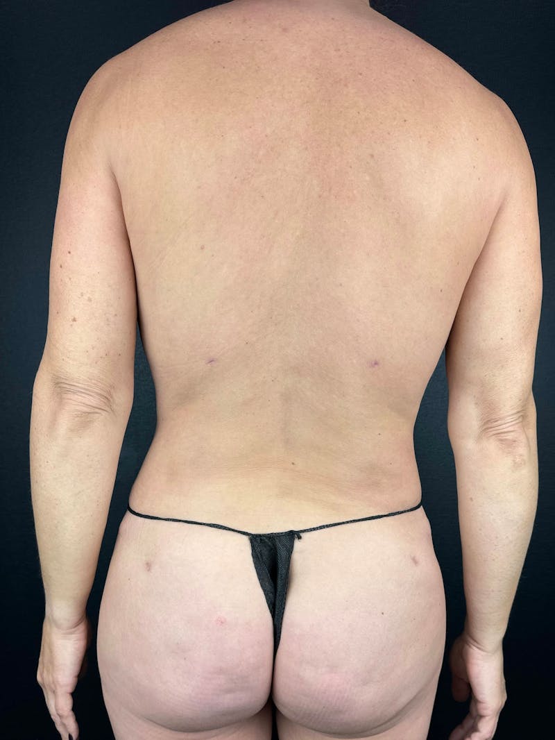 Back (Liposuction) Before & After Gallery - Patient 402435 - Image 2