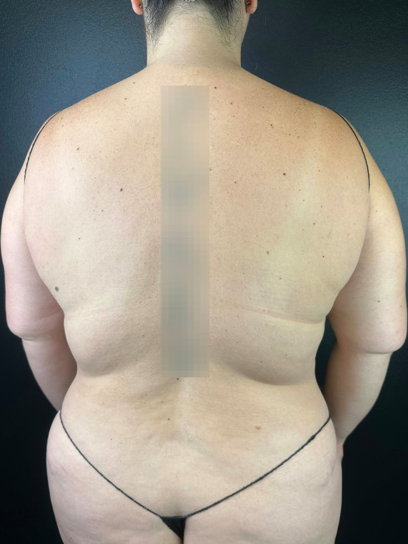 Back (Liposuction) Before & After Gallery - Patient 267176 - Image 1