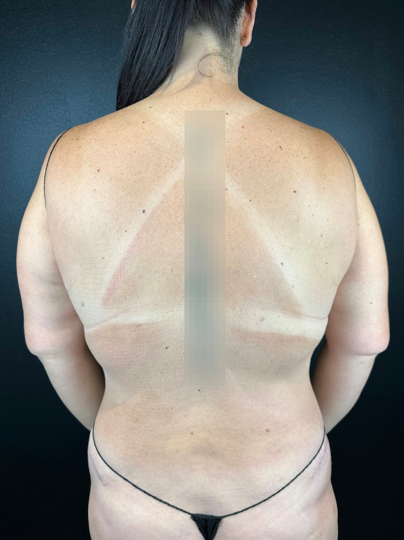 Back (Liposuction) Before & After Gallery - Patient 267176 - Image 2