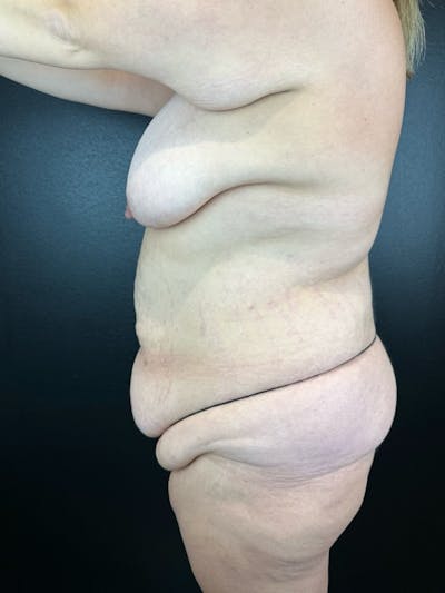 Lower Body Lift Before & After Gallery - Patient 227116 - Image 1