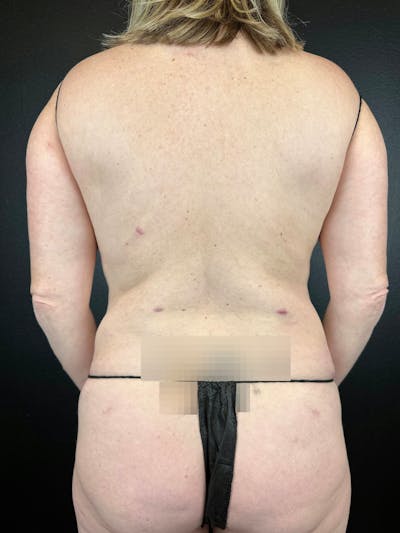 Back (Liposuction) Before & After Gallery - Patient 401939 - Image 2