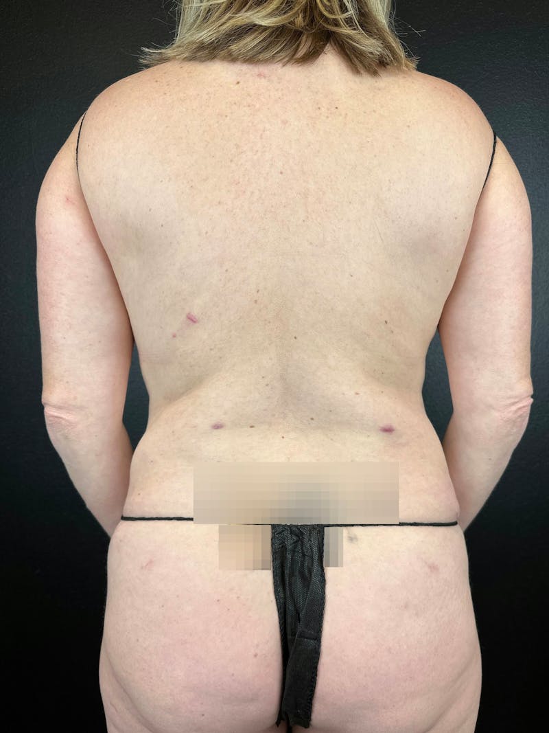 Back (Liposuction) Before & After Gallery - Patient 401939 - Image 2