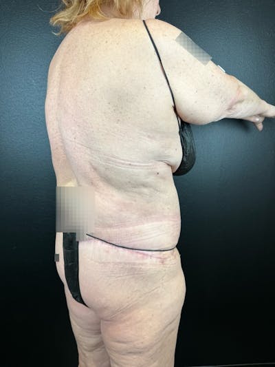 Lower Body Lift Before & After Gallery - Patient 406185 - Image 2