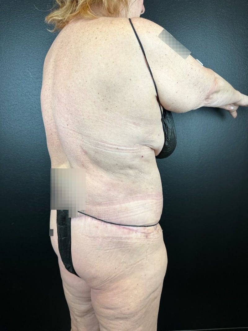 Lower Body Lift Before & After Gallery - Patient 406185 - Image 2