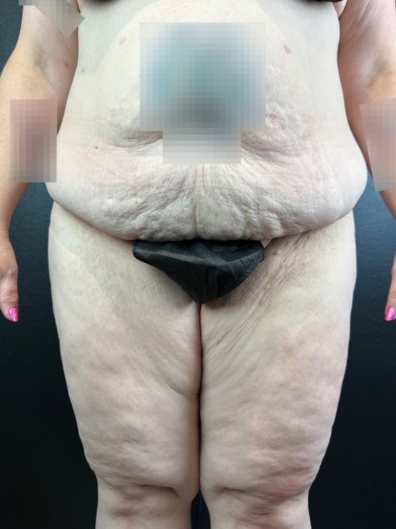 Thigh Lift Before & After Gallery - Patient 159387 - Image 1