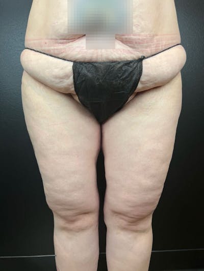 Thigh Lift Before & After Gallery - Patient 159387 - Image 2