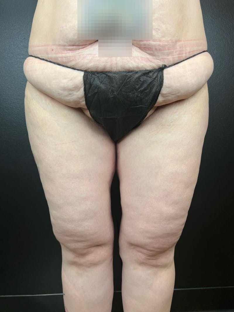 Thigh Lift Before & After Gallery - Patient 159387 - Image 2