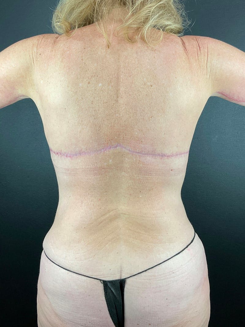 Upper Back Lift Before & After Gallery - Patient 900641 - Image 2
