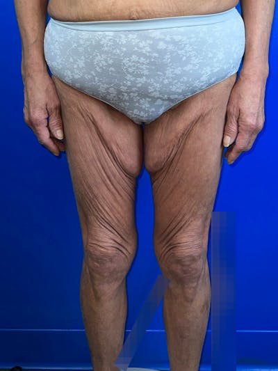 Thigh Lift Before & After Gallery - Patient 374300 - Image 1