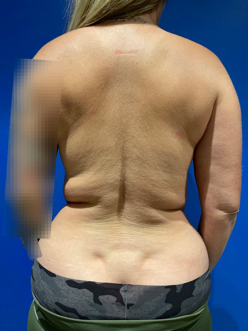 Upper Back Lift Before & After Gallery - Patient 116563 - Image 1