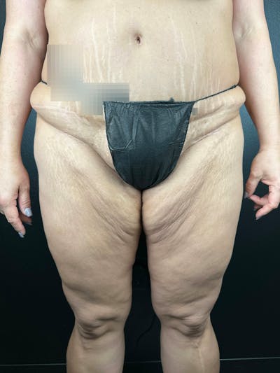 Thigh Lift Before & After Gallery - Patient 430685 - Image 1