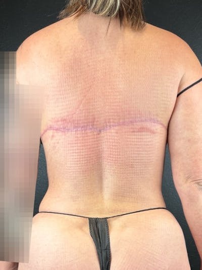 Upper Back Lift Before & After Gallery - Patient 116563 - Image 2