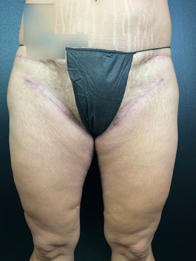 Thigh Lift Before & After Gallery - Patient 430685 - Image 2