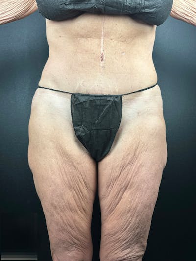 Thigh Lift Before & After Gallery - Patient 765438 - Image 1