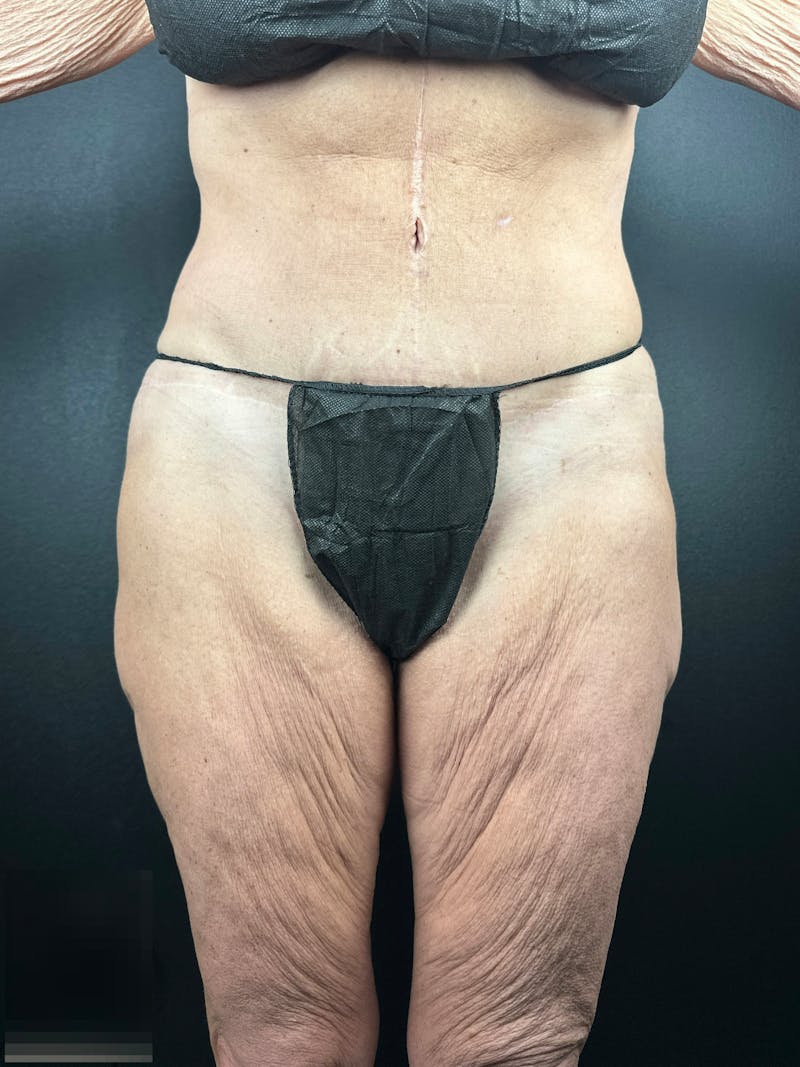 Thigh Lift Before & After Gallery - Patient 765438 - Image 1