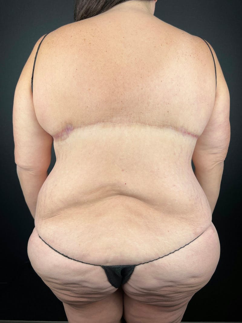 Upper Back Lift Before & After Gallery - Patient 358029 - Image 2