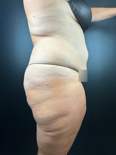 Legs (Liposuction) Before & After Gallery - Patient 372152 - Image 1