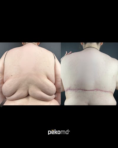 Upper Back Lift Before & After Gallery - Patient 155587 - Image 1