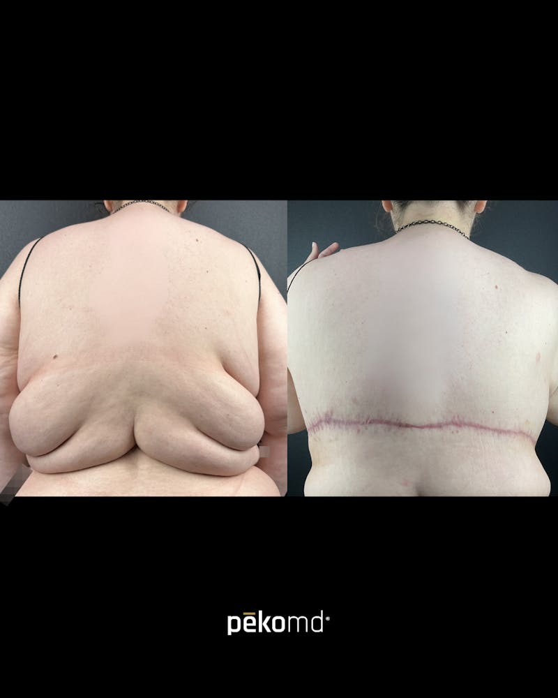 Upper Back Lift Before & After Gallery - Patient 155587 - Image 1