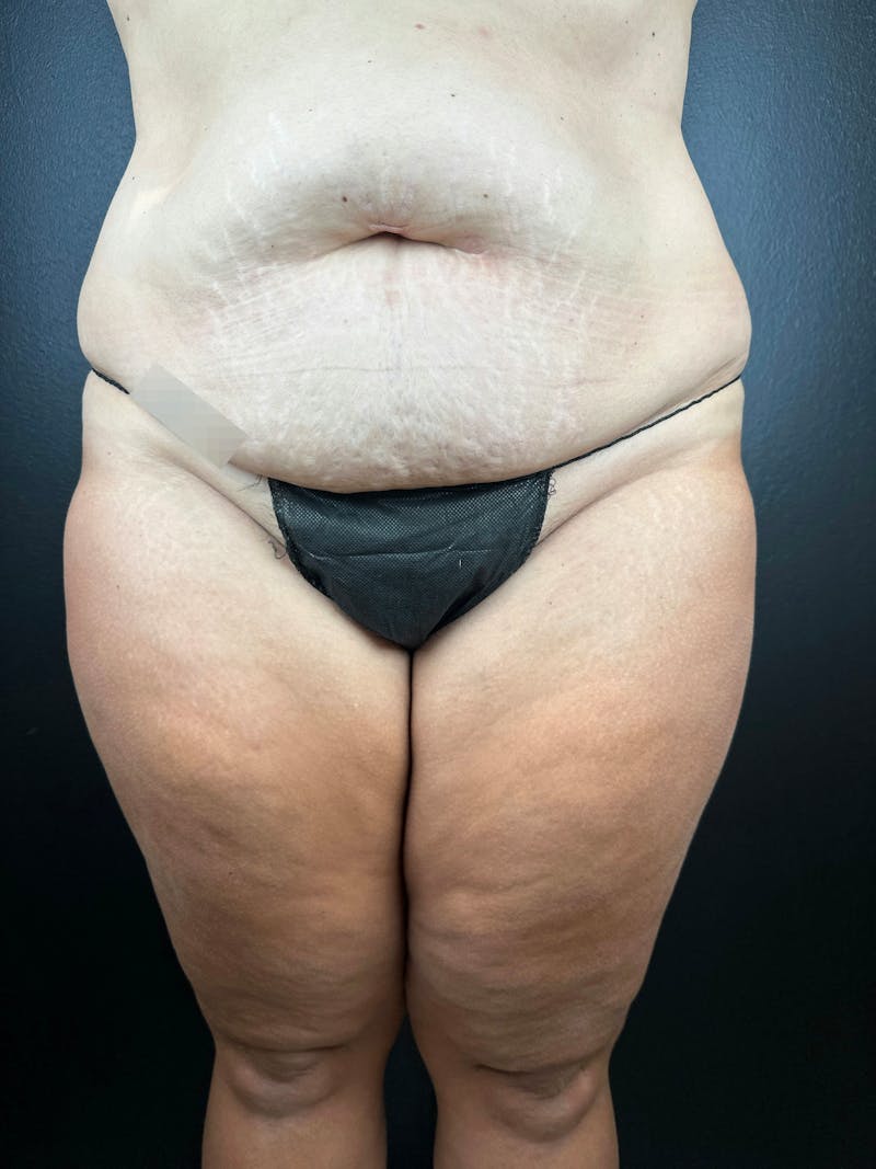 Legs (Liposuction) Before & After Gallery - Patient 372152 - Image 3