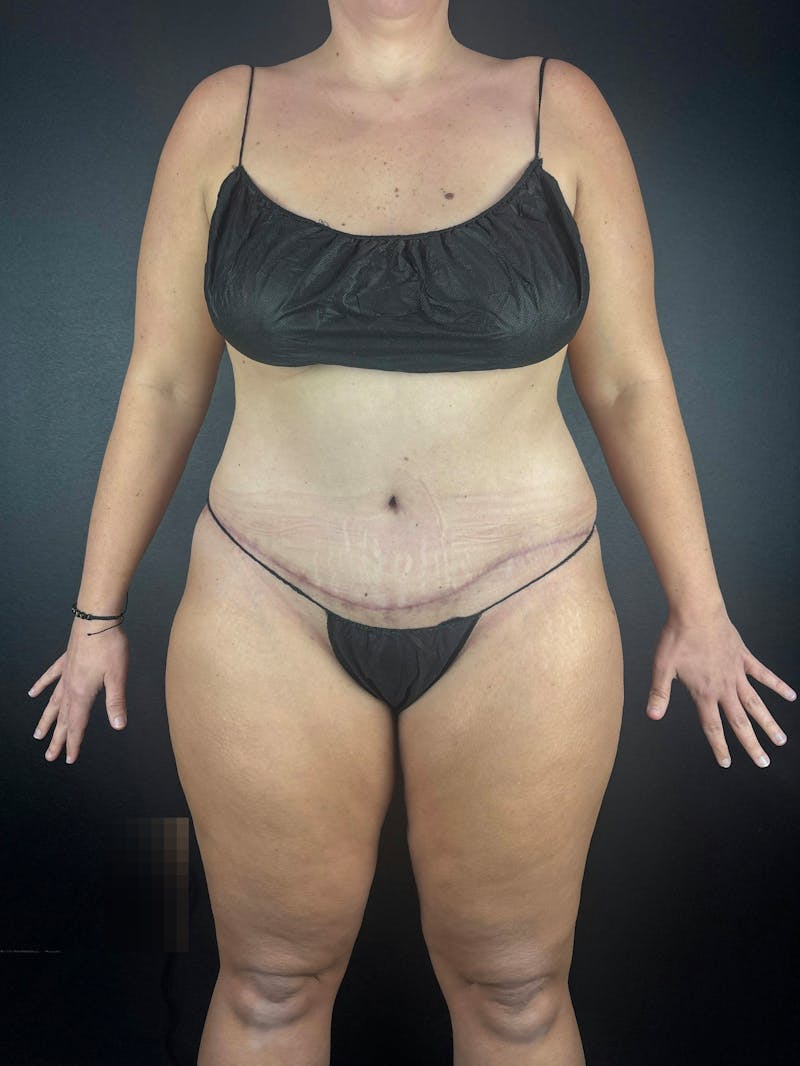 Legs (Liposuction) Before & After Gallery - Patient 372152 - Image 4