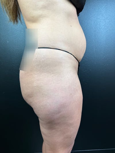 Legs (Liposuction) Before & After Gallery - Patient 156328 - Image 1