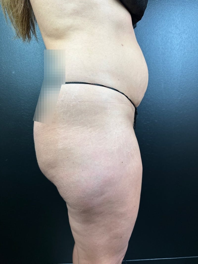 Legs (Liposuction) Before & After Gallery - Patient 156328 - Image 1