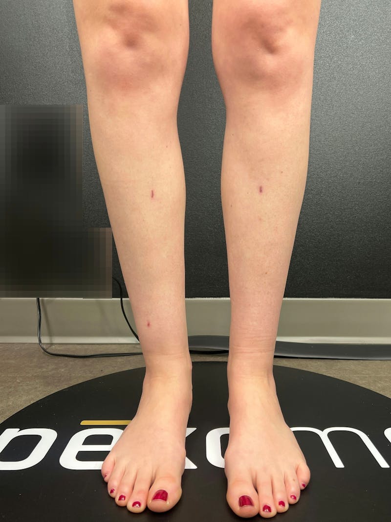Legs (Liposuction) Before & After Gallery - Patient 483622 - Image 4
