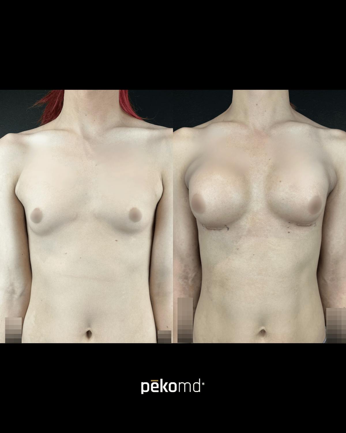 Feminization/MTF Surgery  Before & After Gallery - Patient 106636 - Image 1