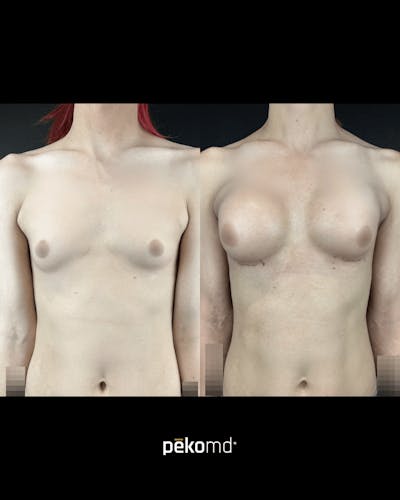 Feminization/MTF Surgery  Before & After Gallery - Patient 106636 - Image 1