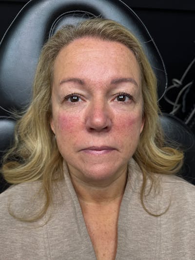 pēko SELF Enhancement (Advanced PRP) Before & After Gallery - Patient 303418 - Image 2