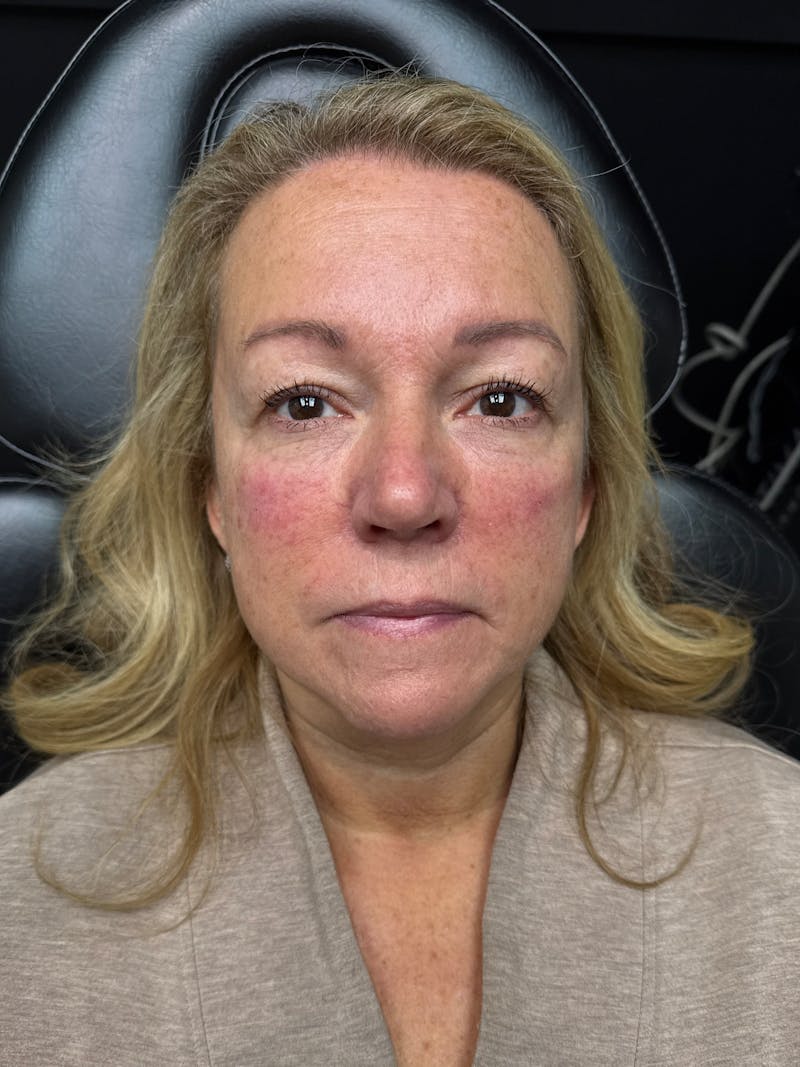 pēko SELF Enhancement (Advanced PRP) Before & After Gallery - Patient 303418 - Image 2