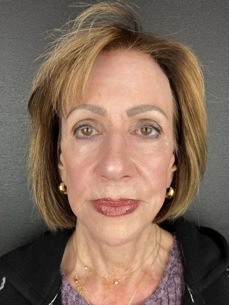 Skin Tightening Before & After Gallery - Patient 325203 - Image 4