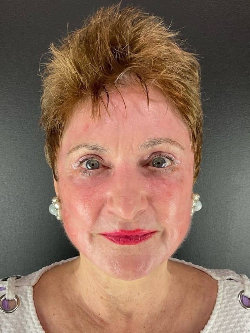Skin Tightening Before & After Gallery - Patient 139254 - Image 2